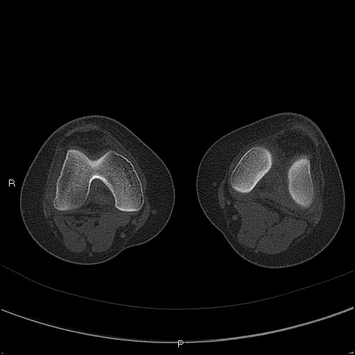 Chondroblastoma (Radiopaedia 62721-71030 Axial bone window 27).jpg