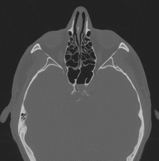 Chondrosarcoma (clivus) (Radiopaedia 46895-51425 Axial bone window 36).png