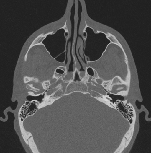 Chondrosarcoma (clivus) (Radiopaedia 46895-51425 Axial bone window 52).png