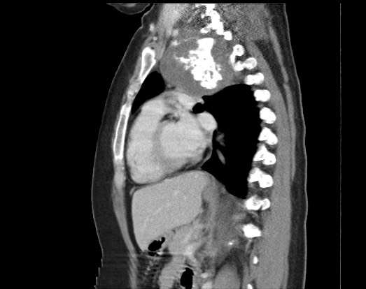 Chondrosarcoma - chest wall (Radiopaedia 65192-74199 B 27).jpg