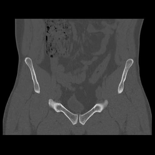 Chondrosarcoma of iliac wing (Radiopaedia 63861-72599 Coronal bone window 39).jpg
