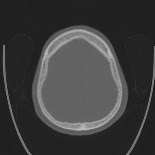 File:Chondrosarcoma of skull base- grade II (Radiopaedia 40948-43653 Axial bone window 40).png