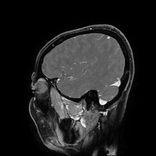 Chordoid glioma of third ventricle (Radiopaedia 91612-109340 F 55).jpg