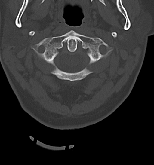 File:Chordoma (C4 vertebra) (Radiopaedia 47561-52188 Axial bone window 8).png