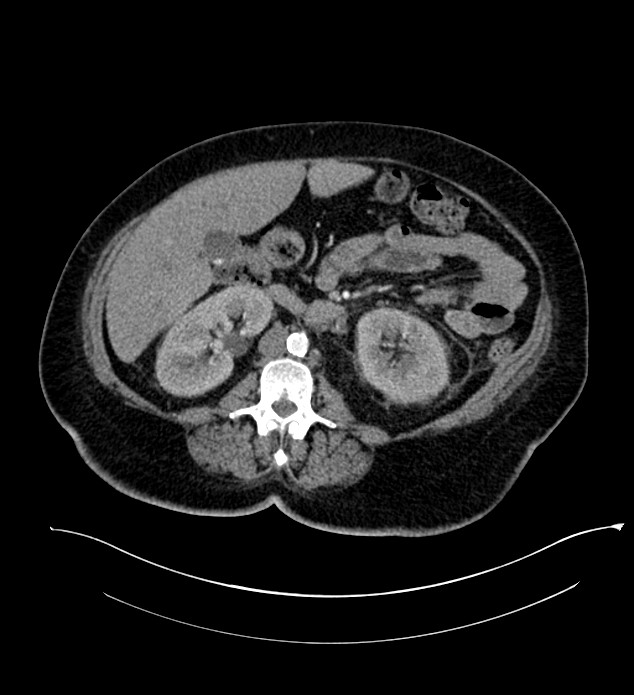 Chromophobe renal cell carcinoma (Radiopaedia 84239-99519 B 59).jpg