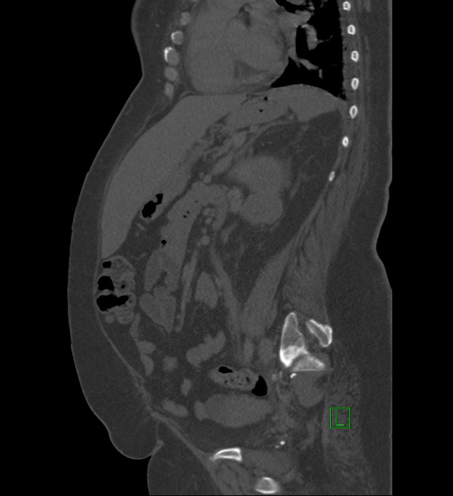 Chromophobe renal cell carcinoma (Radiopaedia 84239-99519 Sagittal bone window 42).jpg