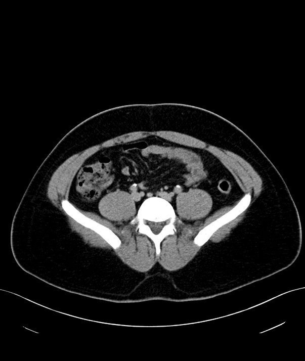 Chromophobe renal cell carcinoma (Radiopaedia 84255-99542 H 38).jpg