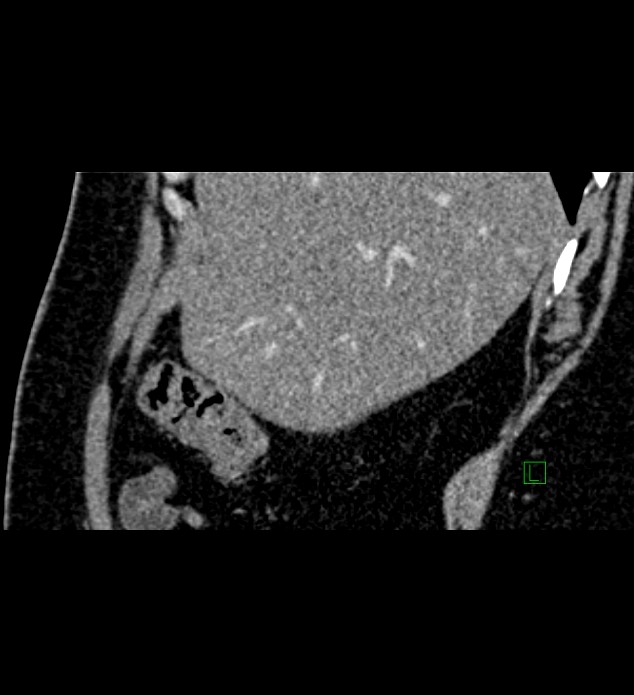 Chromophobe renal cell carcinoma (Radiopaedia 84286-99573 F 143).jpg