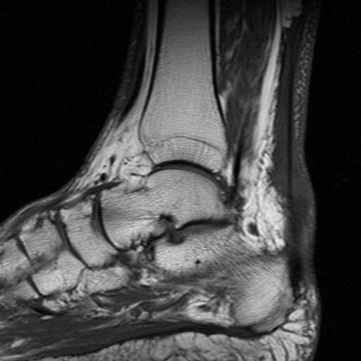 File:Chronic Achilles tendon rupture (Radiopaedia 15262-15100 Sagittal T1 8).jpg