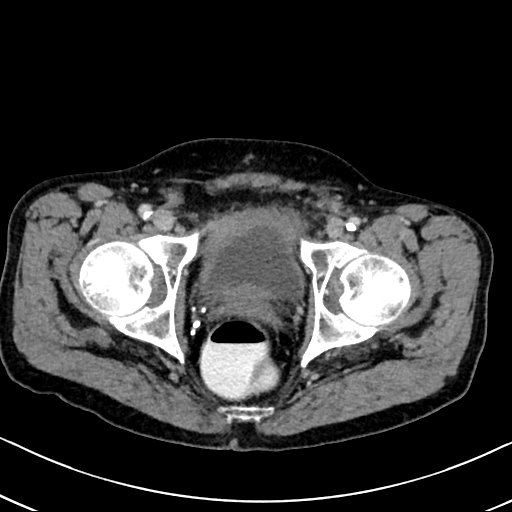 Chronic appendicitis complicated by appendicular abscess, pylephlebitis and liver abscess (Radiopaedia 54483-60700 B 138).jpg