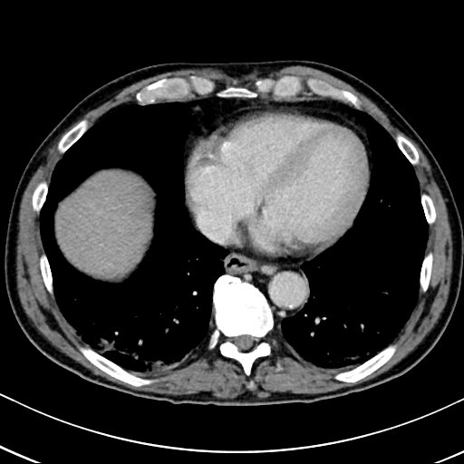 Chronic appendicitis complicated by appendicular abscess, pylephlebitis and liver abscess (Radiopaedia 54483-60700 B 18).jpg