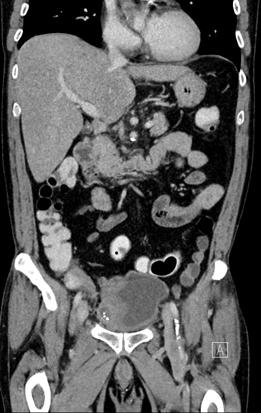 Chronic appendicitis complicated by appendicular abscess, pylephlebitis and liver abscess (Radiopaedia 54483-60700 C 35).jpg