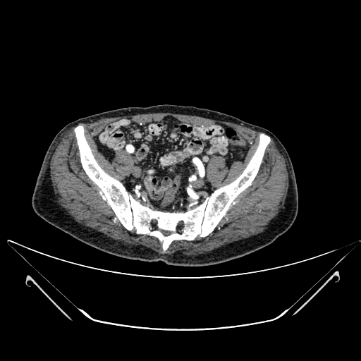 Chronic contained rupture of abdominal aortic aneurysm with extensive erosion of the vertebral bodies (Radiopaedia 55450-61901 A 61).jpg