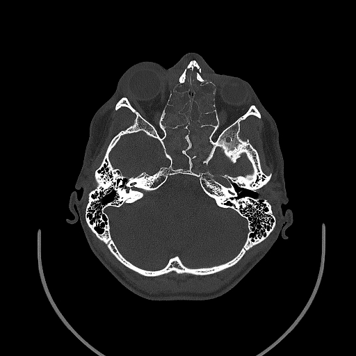 Chronic invasive fungal sinusitis (Radiopaedia 50342-55710 Axial bone window 67).jpg