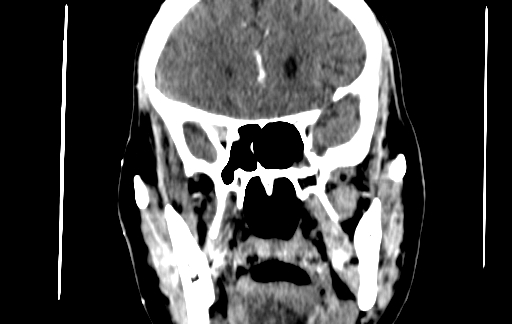 Chronic invasive fungal sinusitis (Radiopaedia 91563-109286 D 77).jpg