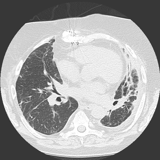 Chronic lung allograft dysfunction - restrictive form (Radiopaedia 60595-68316 Axial lung window 37).jpg