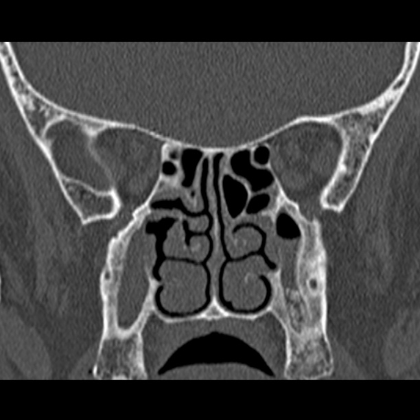 Chronic maxillary sinusitis (Radiopaedia 27879-28116 Coronal bone window 33).jpg
