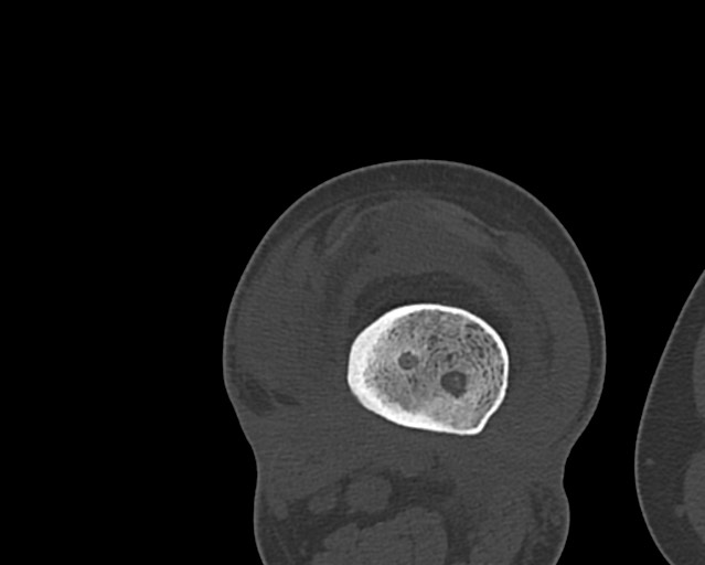 Chronic ostemyelitis of the femur with long sinus tract (Radiopaedia 74947-85982 Axial bone window 177).jpg