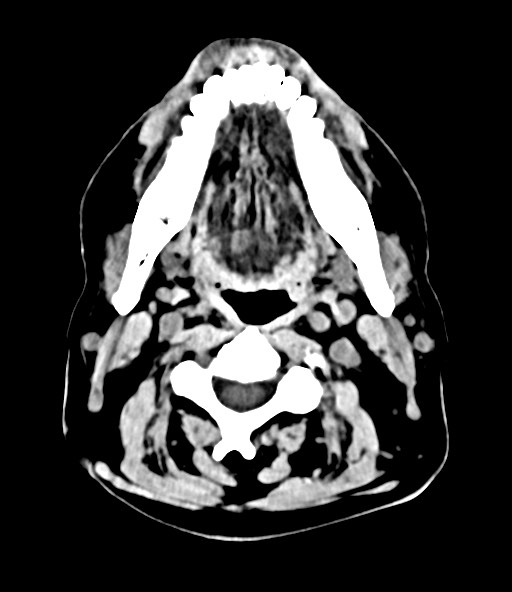 File:Chronic osteomyelitis - calvarial (severe) (Radiopaedia 69668-79616 Axial 137).jpg