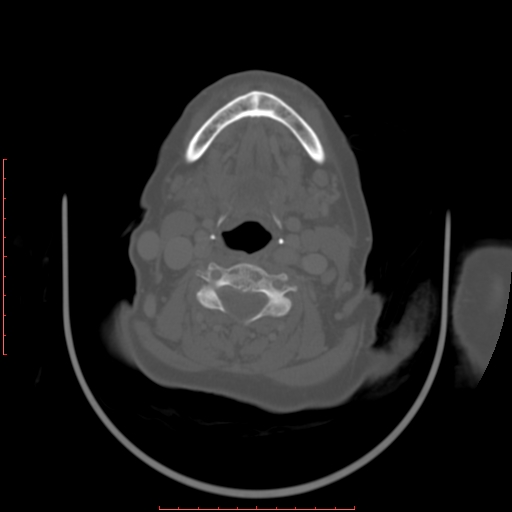 Chronic osteomyelitis - maxilla (Radiopaedia 23783-23927 Axial bone window 16).jpg