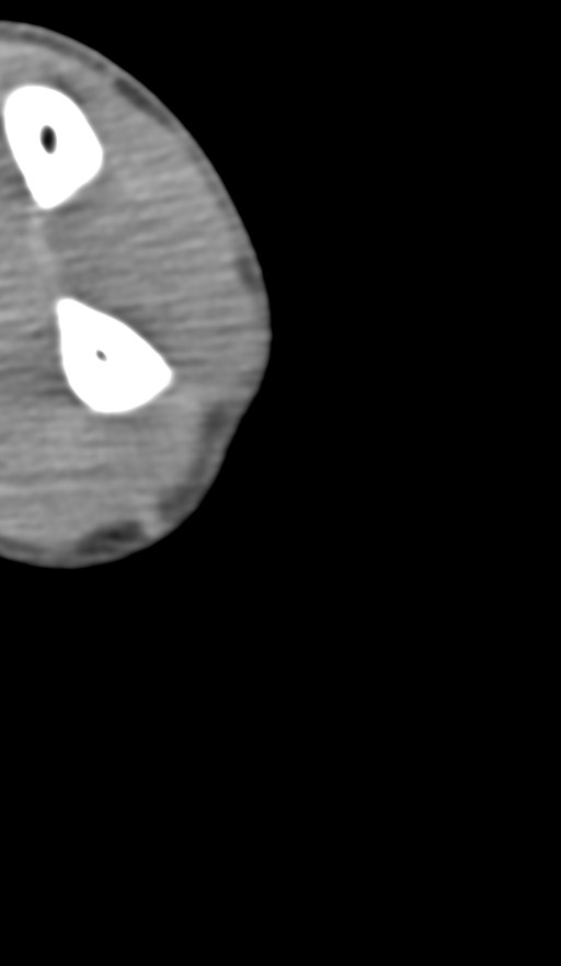 Chronic osteomyelitis of the distal humerus (Radiopaedia 78351-90971 Axial non-contrast 141).jpg