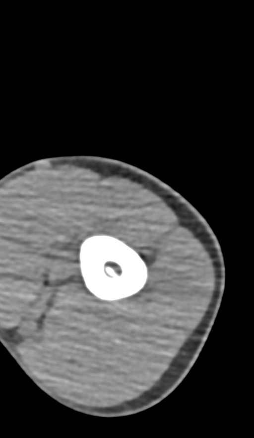 Chronic osteomyelitis of the distal humerus (Radiopaedia 78351-90971 Axial non-contrast 40).jpg