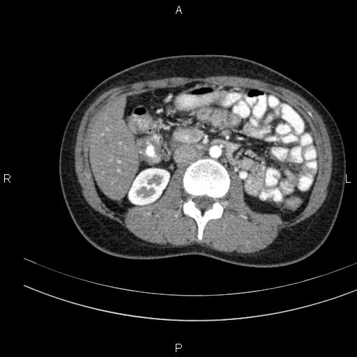 Chronic pancreatitis (Radiopaedia 64576-73450 B 76).jpg