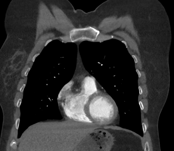 File:Chronic pulmonary embolus (Radiopaedia 39129-41341 Coronal C+ CTPA 28).png