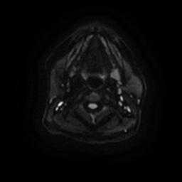 Chronic submandibular sialadenitis (Radiopaedia 61852-69885 Axial DWI 13).jpg