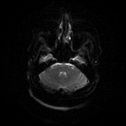 Chronic submandibular sialadenitis (Radiopaedia 61852-69885 Axial DWI 33).jpg