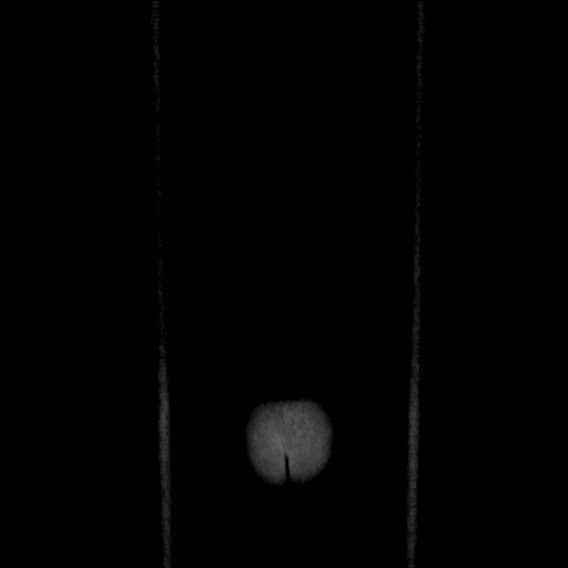 Chronic ureteropelvic junction obstruction (Radiopaedia 78365-90996 B 105).jpg