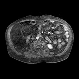 File:Cirrhosis and hepatocellular carcinoma in the setting of hemochromatosis (Radiopaedia 75394-86594 Axial T1 C+ fat sat 177).jpg