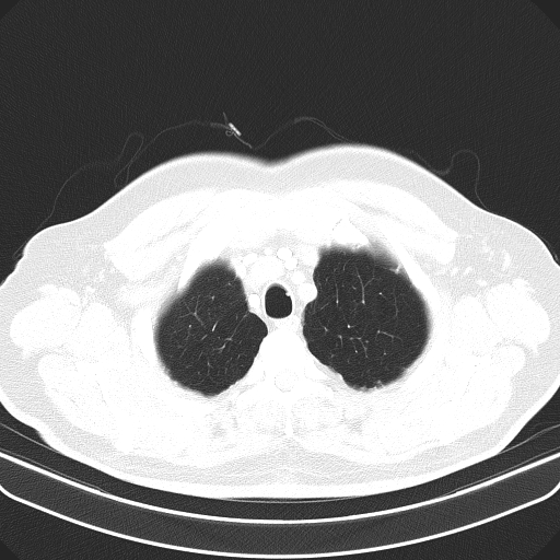 File:Classic complicated silicosis (Radiopaedia 49720-54961 Axial lung window 6).jpg