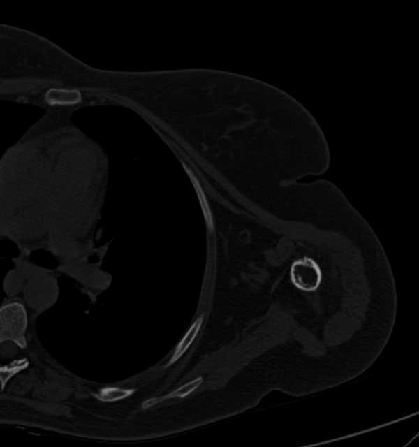 Clear cell chondrosarcoma - humerus (Radiopaedia 63104-71612 Axial bone window 75).jpg