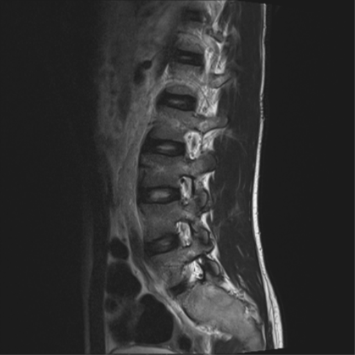 File:Clear cell meningoma - lumbar spine (Radiopaedia 60116-67690 Sagittal T2 4).png