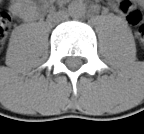 Clear cell meningoma - lumbar spine (Radiopaedia 60116-67691 Axial non-contrast 39).png