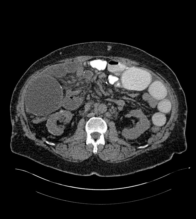 Closed-loop small bowel obstruction-internal hernia (Radiopaedia 78439-91096 Axial non-contrast 70).jpg