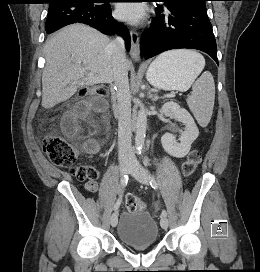 Closed loop obstruction - internal hernia into nephrectomy bed (Radiopaedia 59867-67320 B 75).jpg