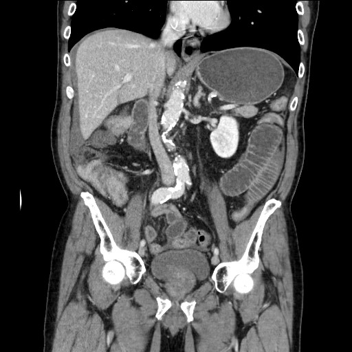 Closed loop obstruction due to adhesive band, resulting in small bowel ischemia and resection (Radiopaedia 83835-99023 E 67).jpg