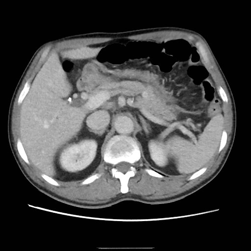Closed loop small bowel obstruction (Radiopaedia 59227-66554 A 29).jpg