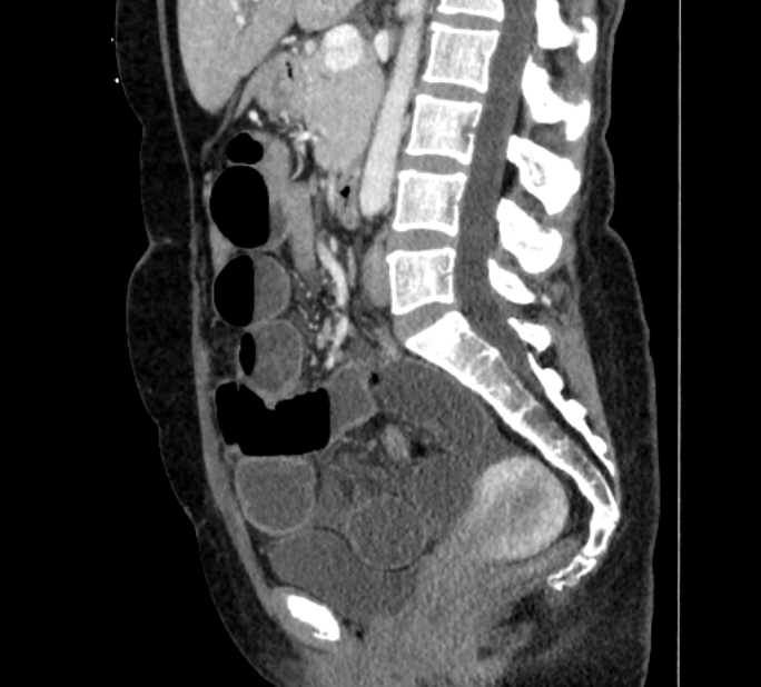 Closed loop small bowel obstruction (Radiopaedia 71211-81508 C 73).jpg