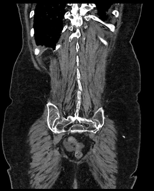 Closed loop small bowel obstruction - adhesions (Radiopaedia 59269-66611 B 107).jpg