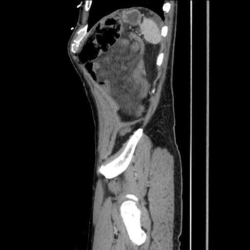 Closed loop small bowel obstruction - omental adhesion causing "internal hernia" (Radiopaedia 85129-100682 C 152).jpg