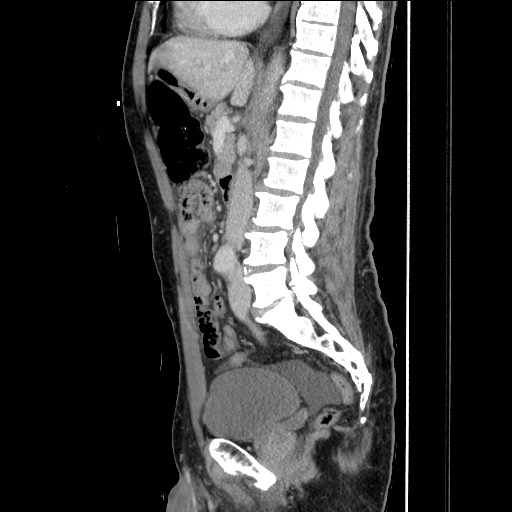 Closed loop small bowel obstruction - omental adhesion causing "internal hernia" (Radiopaedia 85129-100682 C 90).jpg