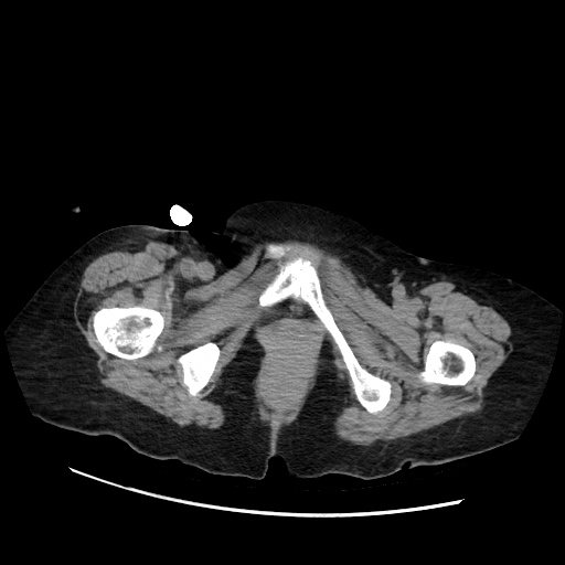 File:Closed loop small bowel obstruction due to adhesive band, with intramural hemorrhage and ischemia (Radiopaedia 83831-99017 Axial non-contrast 165).jpg