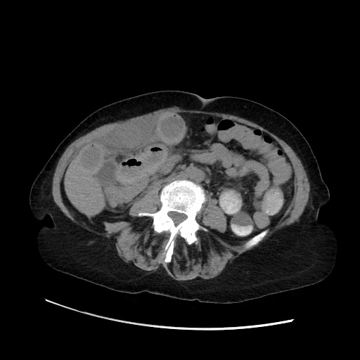 Closed loop small bowel obstruction due to adhesive band, with intramural hemorrhage and ischemia (Radiopaedia 83831-99017 Axial non-contrast 87).jpg