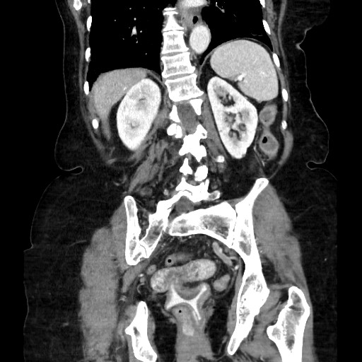 File:Closed loop small bowel obstruction due to adhesive band, with intramural hemorrhage and ischemia (Radiopaedia 83831-99017 C 88).jpg