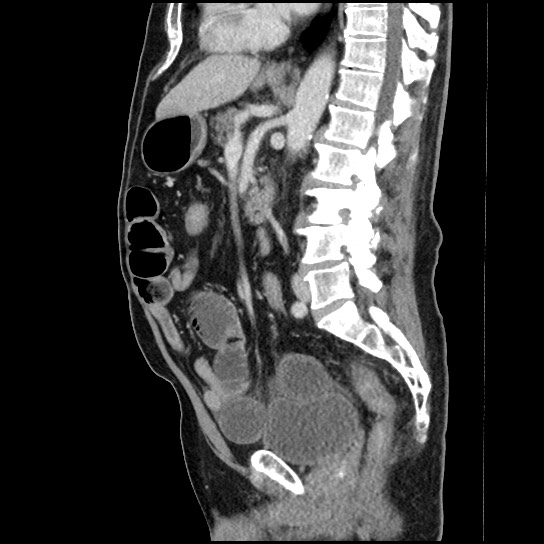 Closed loop small bowel obstruction due to adhesive band - U-shaped loop (Radiopaedia 83829-99012 C 35).jpg