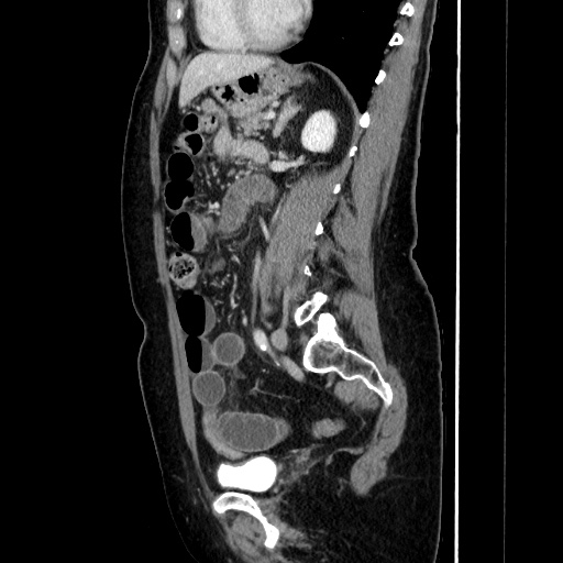 Closed loop small bowel obstruction due to adhesive bands - early and late images (Radiopaedia 83830-99015 C 109).jpg