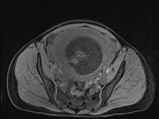 Closed loop small bowel obstruction in pregnancy (MRI) (Radiopaedia 87637-104031 F 45).jpg
